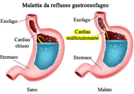 cardias e piloro nel reflusso gastroesofageo