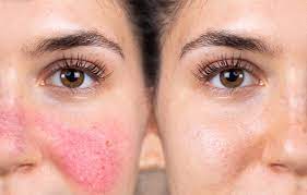 acne rosacea e dieta ortomolecolare come aiuta il naturopata a napoli