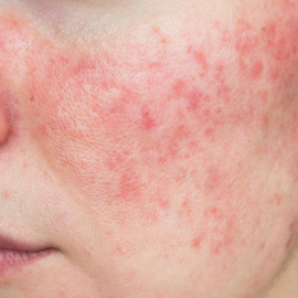 rosacea e dieta ortomolecolare