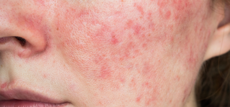 ROSACEA & DIETA ORTOMOLECOLARE: PERCHE’? rosacea e dieta ortomolecolare